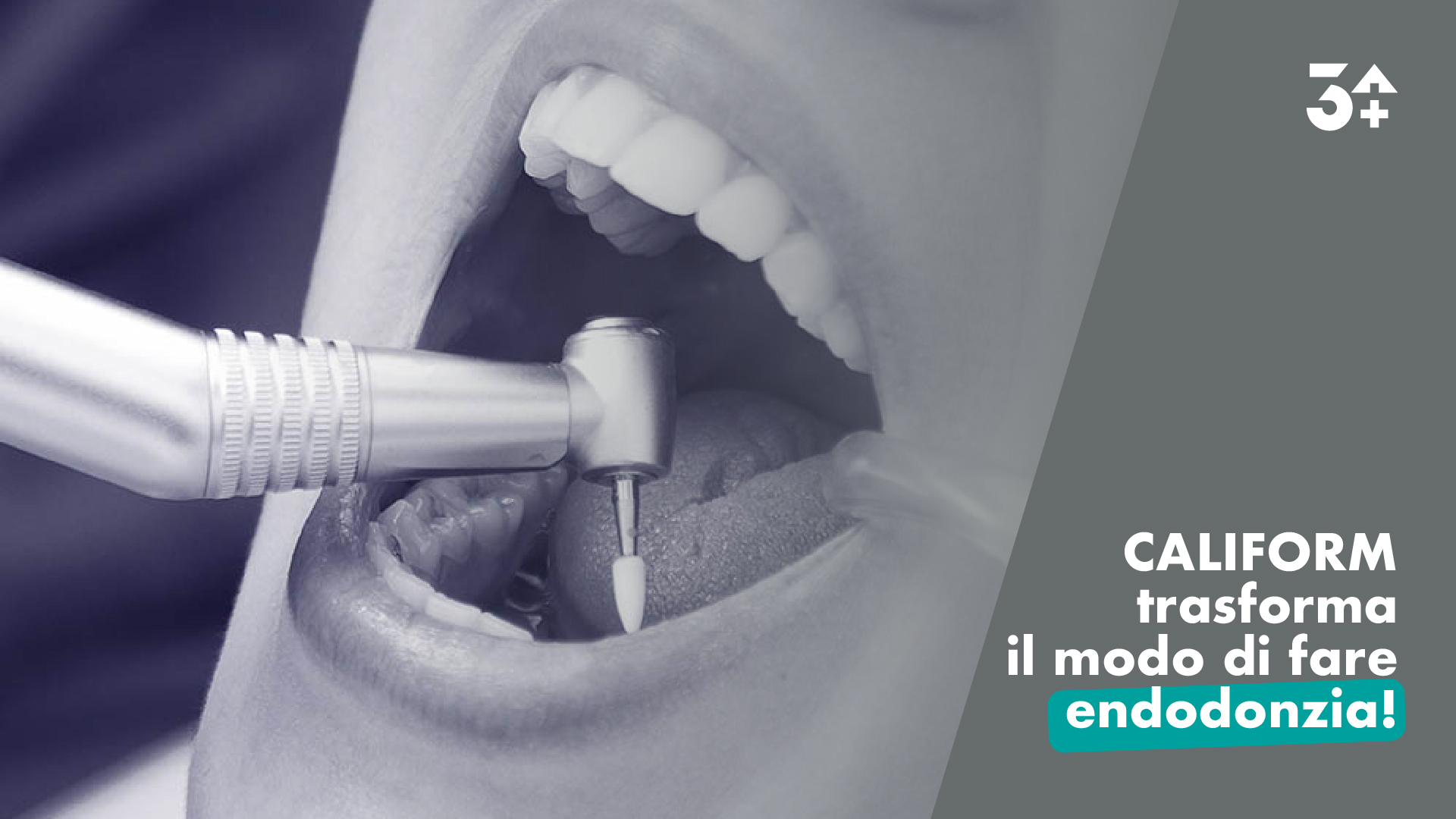 Caliform: la rivoluzione nel trattamento dei canali dentali